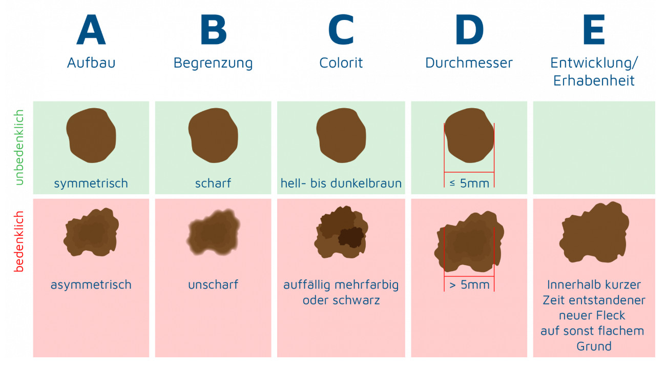 Leberflecke und Muttermale haben einen gleichmäßigen Rand. 