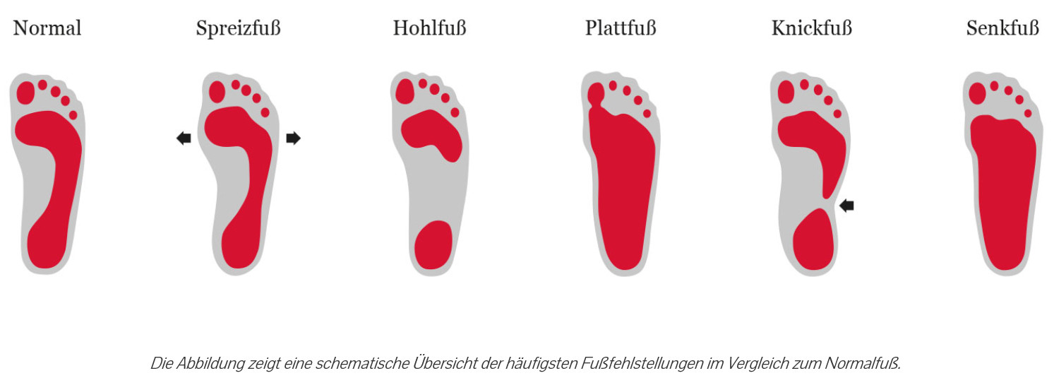 Fußfehlstellungen Eine Übersicht verschiedener Fußabdrücke und den dazugehörenden Fußfehlstellungen