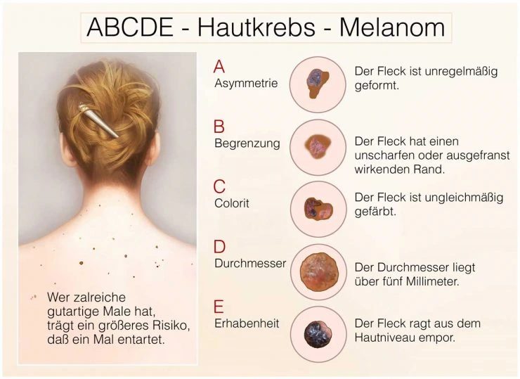 ABCDE - Hautkrebs - Melanom