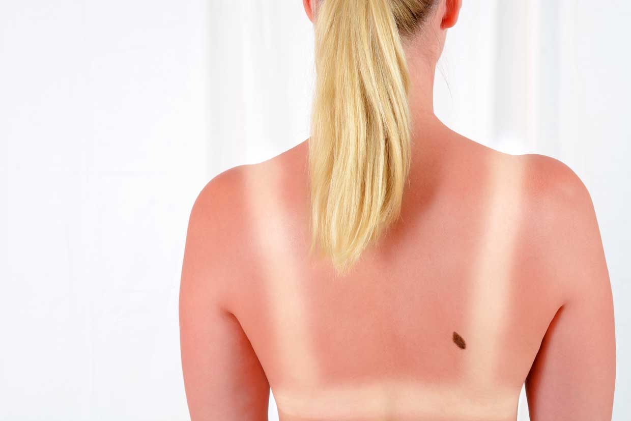 Rücken einer Frau mit Sonnenbrand und Leberfleck