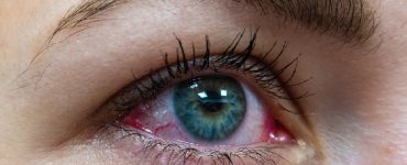 Gerötetes Auge einer Frau in Nahansicht