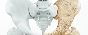 Hüftgelenk bei Osteoporose