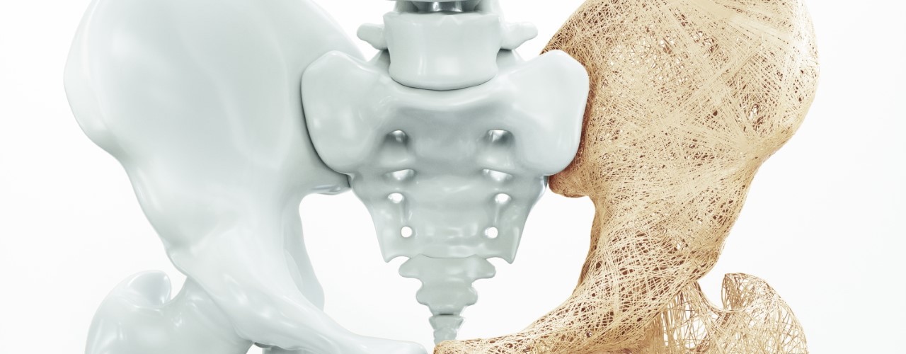 Hüftgelenk bei Osteoporose
