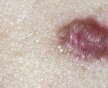Weißer Hautkrebs: Basaliom und Spinaliom erkennen und behandeln