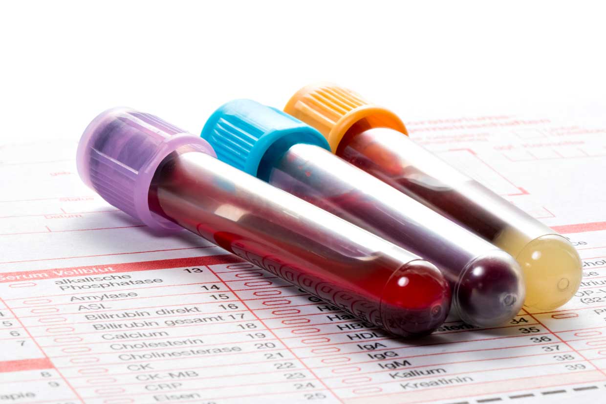 Blutproben zur Untersuchung bei Leukämie